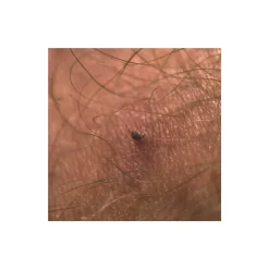 Outlet Tick Remover Tool Insect Protection